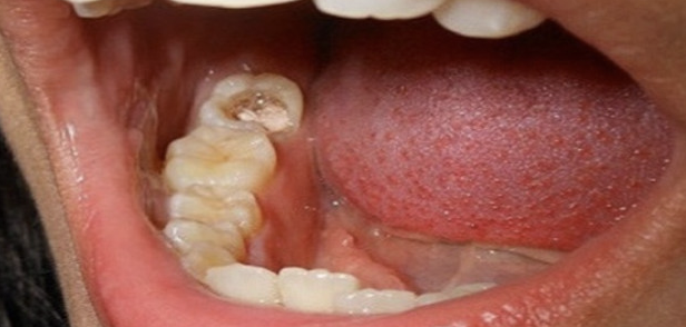 cara merontokan gigi berlubang tanpa dicabut